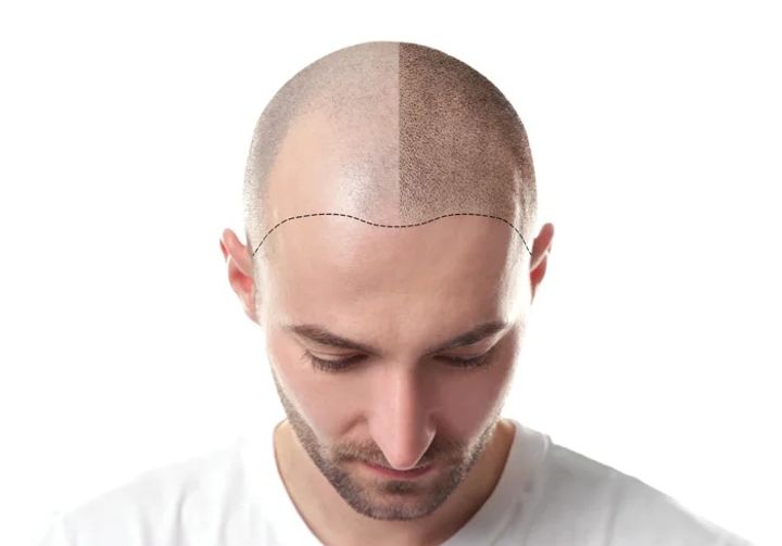 Explore the Basics of Hair Transplant: Everything You Need to Know Before You Start